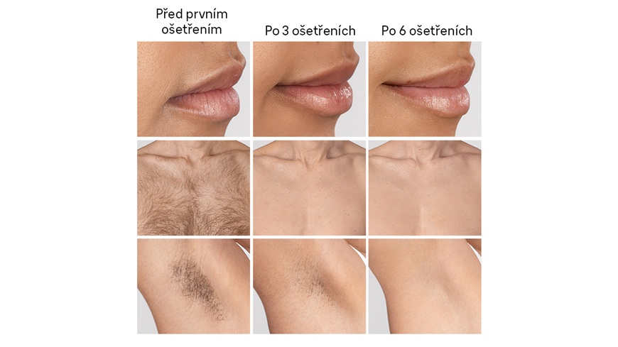 proces mizení chloupků pomocí epilátoru na různých částech těla